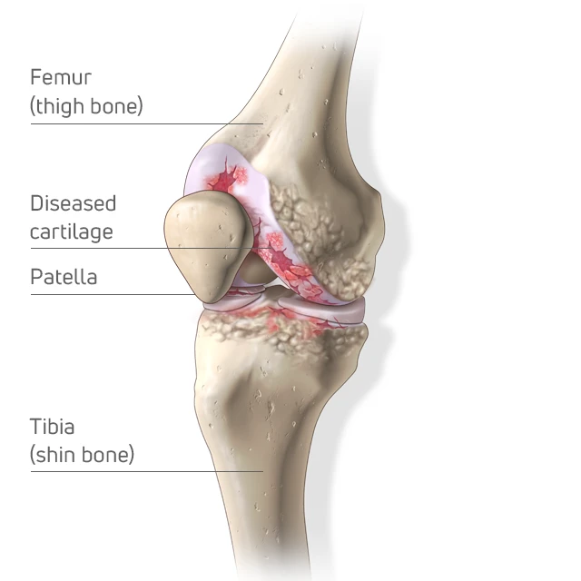 OA Knee Anatomy